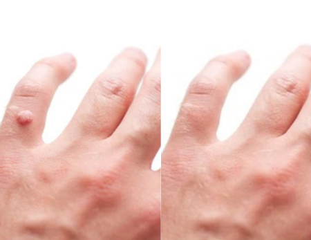 Electrocautery Treatment - Before & After - 1