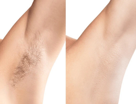 Electrocautery Treatment - Before & After - 3