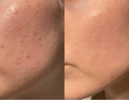 Pigment correction and glow treatments-Before & Afte-1