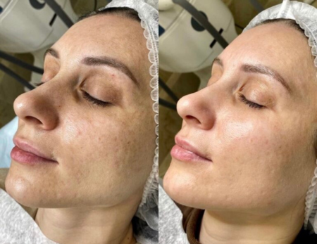 Pigment correction and glow treatments-Before & Afte-2