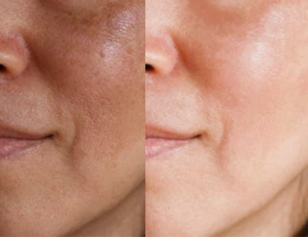 Pigment correction and glow treatments-Before & Afte-3