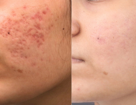 Acne Scar Treatment before & after-1