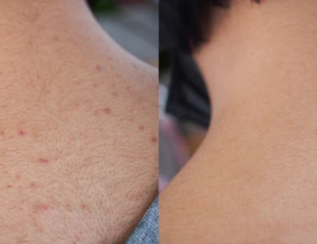 Acne Scar Treatment before & after-2