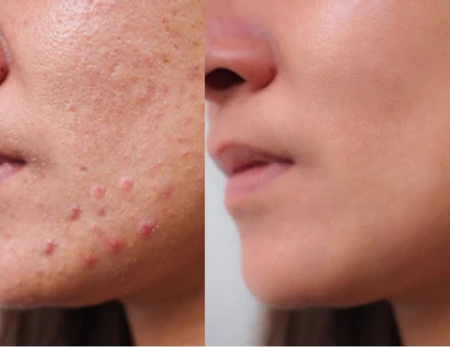 Acne Scar Treatment before & after-3