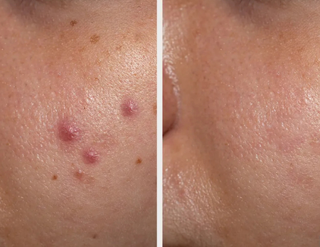 Dr Soma’s Signature treatments before & after-2