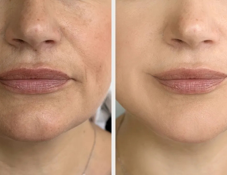 EBD and Injectables before & after-1