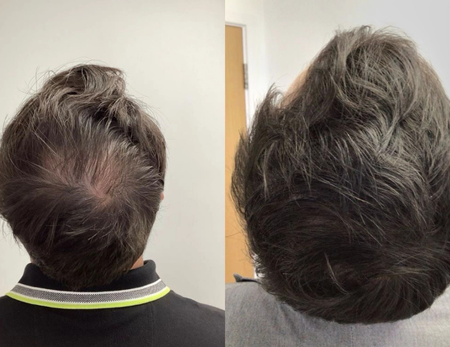 Hair Treatments before & after-1