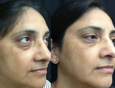 Microneedling before & after-1