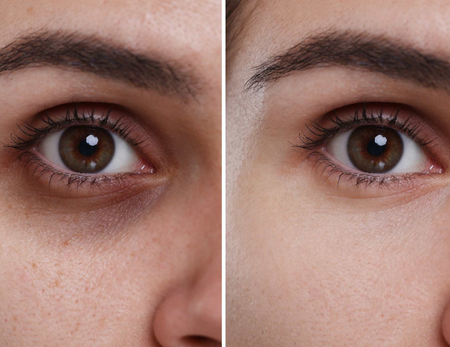 Microneedling before & after-2