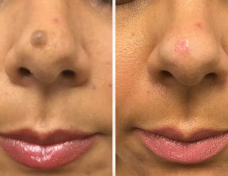 skin before & after-2
