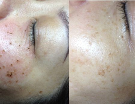 skin before & after-3