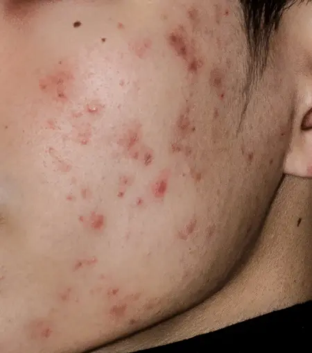 Dermatologist performing acne scar treatment