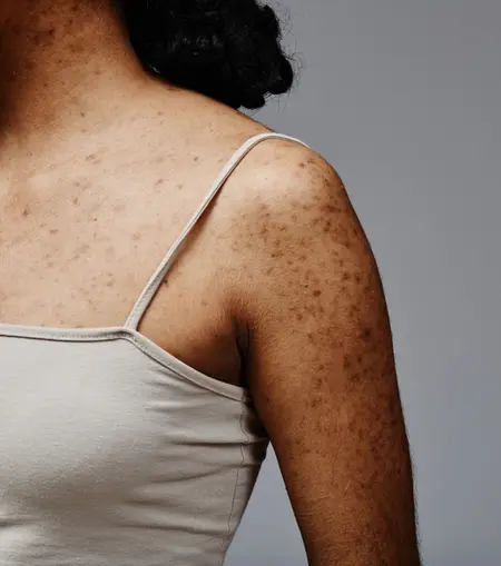 Clinical acne scar correction procedure