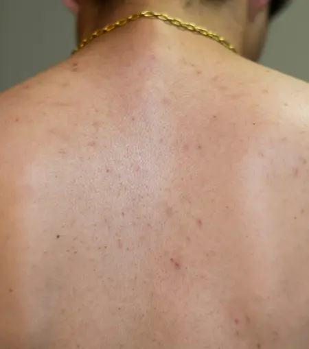 Advanced acne scar removal treatment