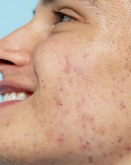 Best Clinical Dermatology in Bangalore