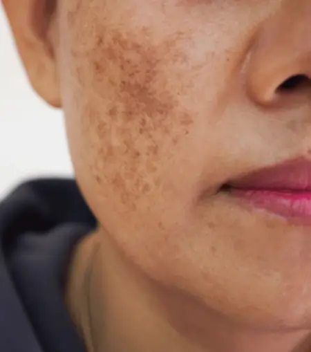 Skin pigmentation and glow treatment in bangalore