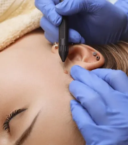 Electrocautery-Treatment