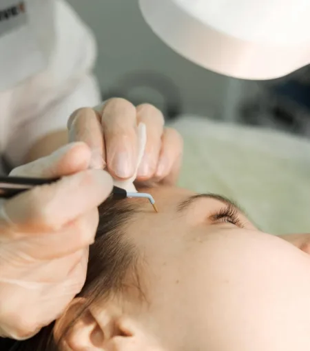 Dermatologist performing electrocautery skin treatment