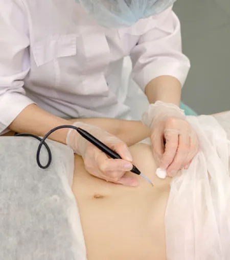 Advanced electrocautery dermatology procedure