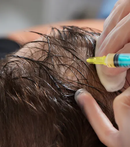 Professional hair regrowth treatment at dermatology clinic