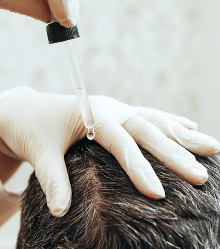 Dermatologist providing hair fall treatment