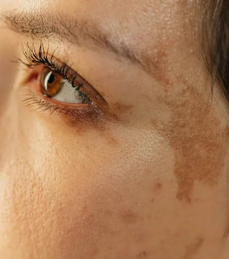 Dermatologist analyse microneedling treatment