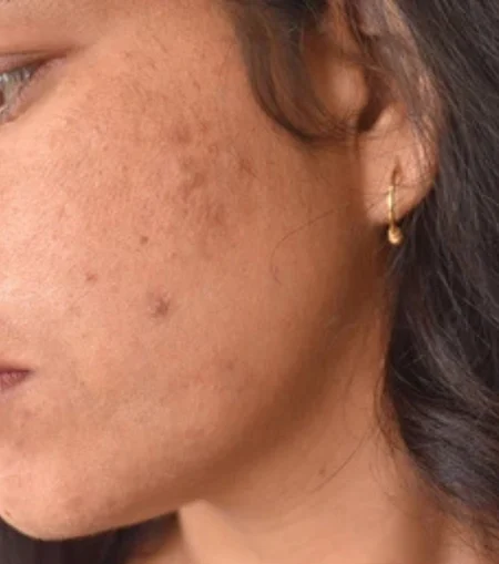 Microneedling procedure performed by a dermatologist