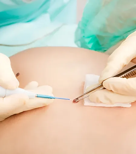 Skin rejuvenation treatment at Soma dermatology clinic