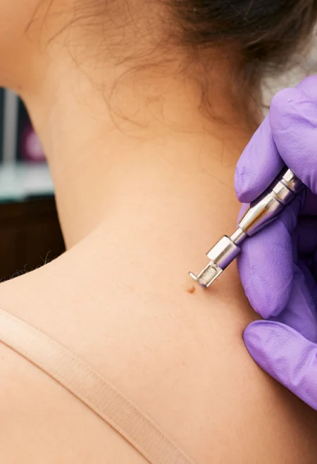 Advanced skin care treatments at Soma Hair and Skin Clinic in Bangalore